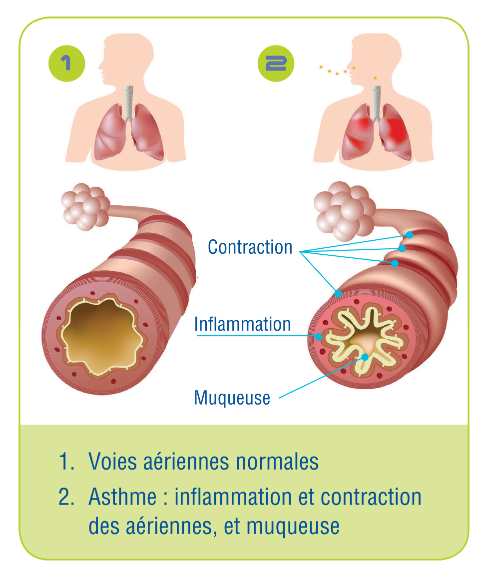 Asthma_airway_F